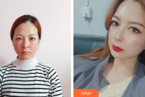 佛山廣美醫(yī)療美容門診部孫凱整形價格表附熱瑪吉案例展示