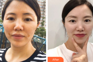 佛山顏植醫(yī)療美容門診部李莉整形價格表附埋線提升案例展示