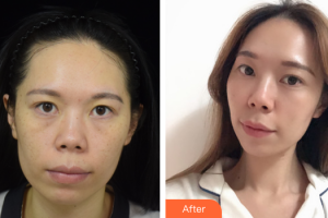 佛山廣美醫(yī)療美容門診部楊群鳳整形價格表附熱拉提緊致除皺案例展示