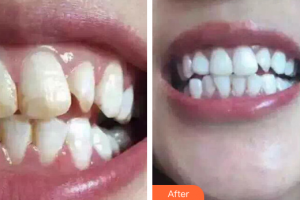 佛山中大口腔醫(yī)院羅明軒整形價格表附皓齒美白案例展示