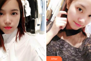 佛山中大口腔醫(yī)院林海權(quán)整形價格表附時代天使矯正案例展示