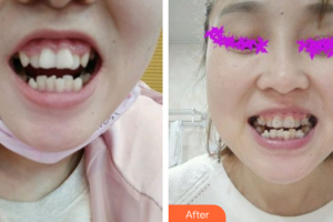 佛山中大口腔醫(yī)院陳文杰整形價格表附牙齒陶瓷矯正案例展示