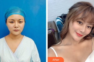 佛山東康整形美容門診部何鎮(zhèn)宇整形價格表附五維錨定眼部手術(shù)案例展示