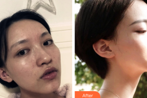 佛山黛顏人醫(yī)療美容門診部鄧勝群整形價格表附水光補水案例展示