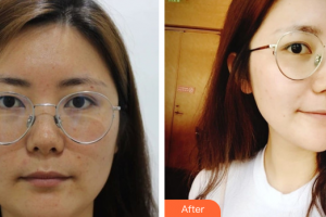 佛山黛顏人醫(yī)療美容門診部李忠隨整形價格表附面部吸脂案例展示