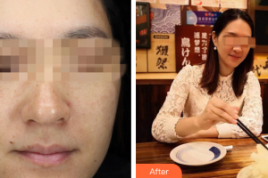 佛山廣文皮膚科醫(yī)院孫光選整形價格表附光子嫩膚案例展示