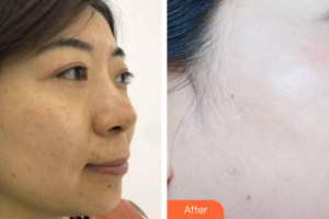 佛山華美整形美容醫(yī)院羅宇康整形價格表附BBL祛斑案例展示