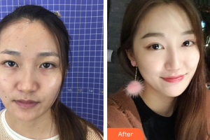 佛山美萊醫(yī)療美容醫(yī)院王燕整形價格表附鼻部手術(shù)案例展示