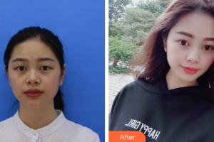 佛山美萊醫(yī)療美容醫(yī)院劉永揚整形價格表附眼部整形案例展示