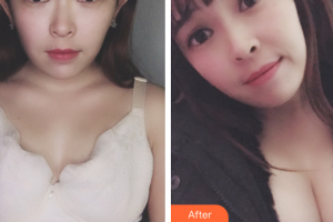 佛山美萊醫(yī)療美容醫(yī)院孫靖整形價格表附自體脂肪隆胸案例展示