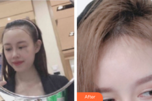 佛山華美整形美容醫(yī)院肖吉輔整形價格表附種植發(fā)際線案例展示