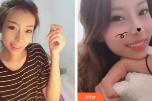 佛山市禪城區(qū)人民醫(yī)院口腔?？漆t(yī)院關達榮整形價格表附隱形矯正案例展示