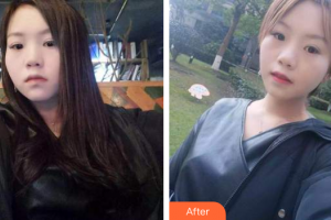 佛山市禪城區(qū)人民醫(yī)院口腔?？漆t(yī)院陳月明整形價格表附時代天使矯正案例展示