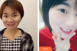 佛山市禪城區(qū)人民醫(yī)院口腔?？漆t(yī)院陳覺清整形價格表附隱形矯正案例展示