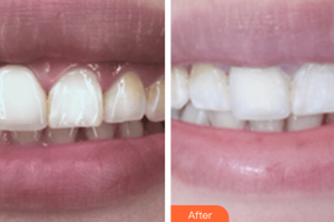 佛山南海中大口腔醫(yī)院陳亞梅整形價格表附超聲波洗牙案例展示