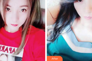 佛山順德口腔醫(yī)院蔣雅賢整形價格表附超聲波潔牙案例展示