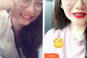 佛山市禪城區(qū)人民醫(yī)院口腔專科醫(yī)院鄒康元整形價格表附金屬矯正案例展示