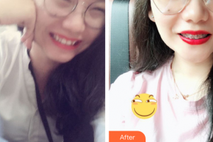 佛山市禪城區(qū)人民醫(yī)院口腔?？漆t(yī)院李業(yè)榮整形價格表附金屬矯正案例展示