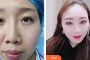 佛山市禪城中心醫(yī)院整形美容科曹碧浪整形價格表附眼部修復案例展示