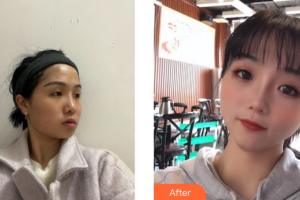 江門市五邑中醫(yī)院整形科李宇明整形價格表附埋線提升提升案例展示