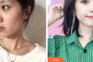 江門福康醫(yī)學整形美容醫(yī)院蔡劍芳整形價格表附激光美膚激光祛斑案例展示