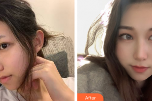 江門僑都華美美容醫(yī)院歐國升整形價格表附面部填充案例展示