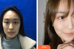 江門僑都華美美容醫(yī)院林社彬院長整形價(jià)格表附美眼案例展示