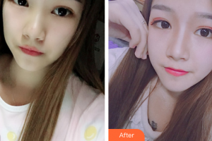 江門僑都華美美容醫(yī)院毛孝中整形價(jià)格表附耳軟骨復(fù)合隆鼻案例展示