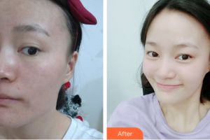 湛江東盟整形美容醫(yī)院沈剛整形價(jià)格表附微針案例展示