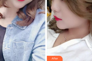 湛江市第一中醫(yī)院整形美容中心趙娜娜醫(yī)師整形價(jià)格表附激光美膚激光案例展示