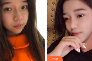 湛江中心人民醫(yī)院燒傷整形手外科陳審整形價(jià)格表附激光祛斑案例展示