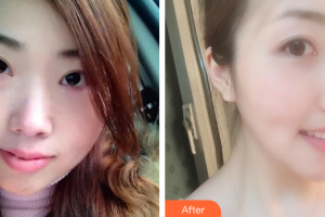 湛江澳泰整形美容醫(yī)院陳突整形價(jià)格表附金屬矯正案例展示