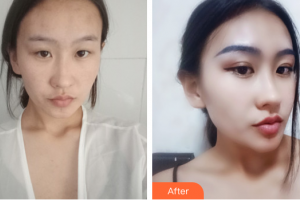 湛江澳泰整形美容醫(yī)院朱志杰整形價(jià)格表附眼部手術(shù)案例展示