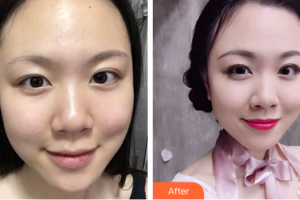 湛江華美整形美容醫(yī)院顏忠蓮整形價(jià)格表附激光美膚激光祛斑案例展示