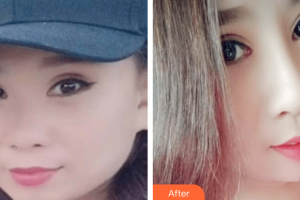 湛江東盟整形美容醫(yī)院張俊整形價(jià)格表附鼻部綜合案例展示