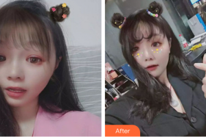 湛江東盟整形美容醫(yī)院王瑤整形價(jià)格表附果酸煥膚案例展示