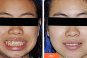 湛江南方口腔醫(yī)院袁兵整形價格表附矯正牙齒案例展示