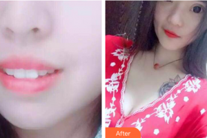 湛江南方口腔醫(yī)院吳曉程整形價格表附時代天使矯正案例展示