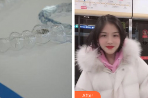 湛江南方口腔醫(yī)院蔡羽飛整形價格表附隱形矯正案例展示