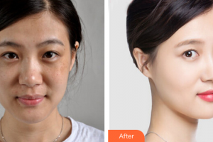 茂名市人民醫(yī)院燒傷整形科邱世國整形價格表附激光祛斑案例展示