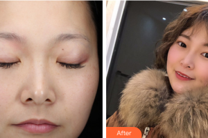 茂名市人民醫(yī)院燒傷整形科董嘉藍整形價格表附激光祛斑案例展示