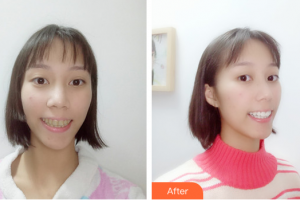 茂名華美整形美容醫(yī)院王玉強整形價格表附瓷貼面案例展示