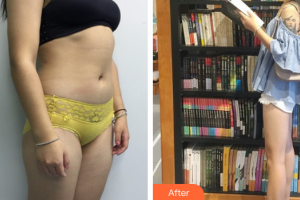 茂名華美整形美容醫(yī)院田艷軍整形價格表附大腿吸脂案例展示