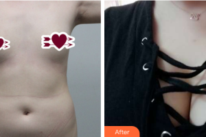 茂名華美整形美容醫(yī)院劉亞飛整形價格表附自體脂肪豐胸案例展示