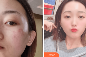 茂名華美整形美容醫(yī)院禤麗艮整形價格表附激光祛斑案例展示