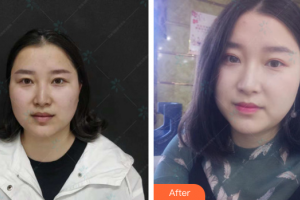 茂名市人民醫(yī)院燒傷整形科董永盛整形價格表附微針水光案例展示