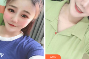 茂名華美整形美容醫(yī)院孟英堂整形價格表附果酸煥膚案例展示