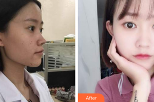 肇慶市第一人民醫(yī)院燒傷整形科鐘展芳整形價格表附嫩膚淡斑微針案例展示