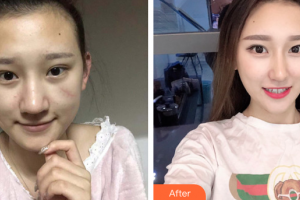 肇慶市第一人民醫(yī)院燒傷整形科姚明昌整形價格表附手術(shù)疤痕案例展示