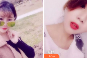 肇慶市第一人民醫(yī)院燒傷整形科周強整形價格表附紅藍光祛痘案例展示